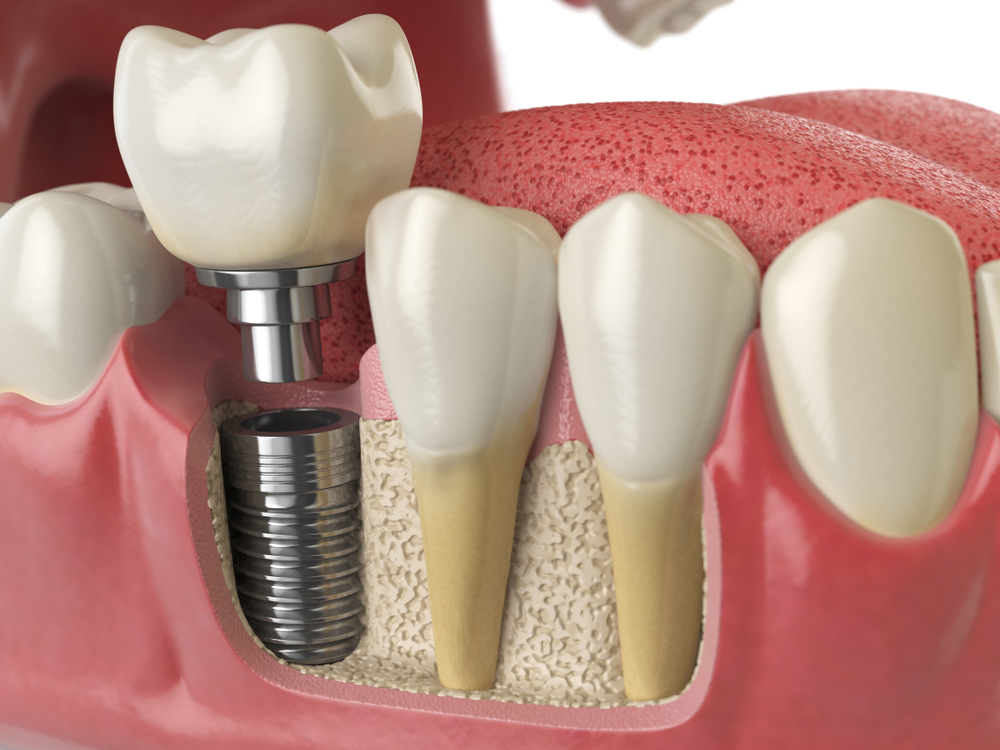 The 3 Stages Of Getting Dental Implants